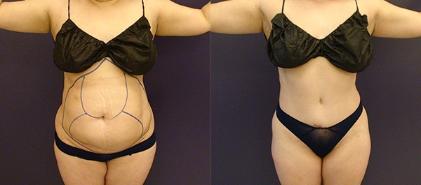 Before and After Image: Patient 11 - front