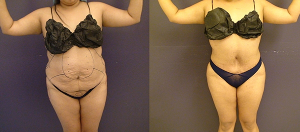 Before and After Image: Patient 12 - front