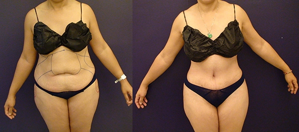 Before and After Image: Patient 13 - front