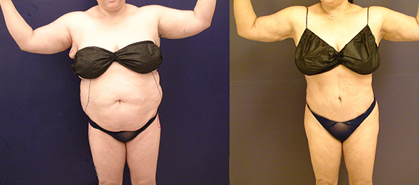 Before and After Image: Patient 14 - front