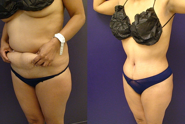 Before and After Image: Patient 15 - left-front-oblique