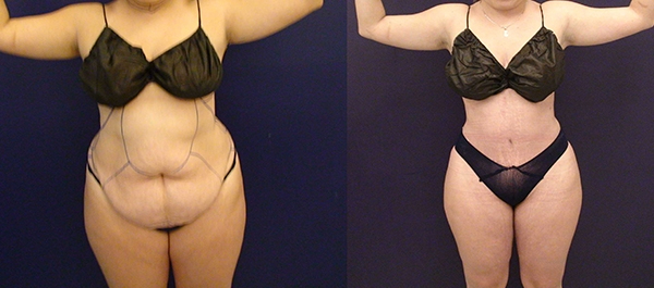 Before and After Image: Patient 16 - front