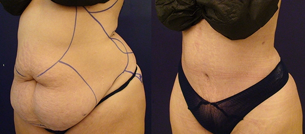 Before and After Image: Patient 16 - left-front-oblique