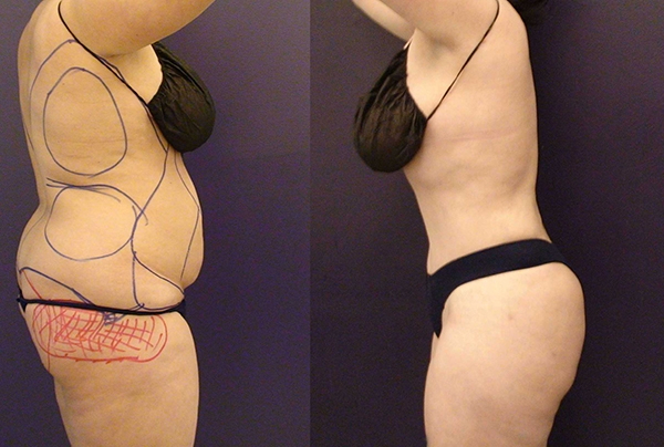 Before and After Image: Patient 17 - other
