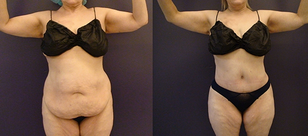 Before and After Image: Patient 18 - front