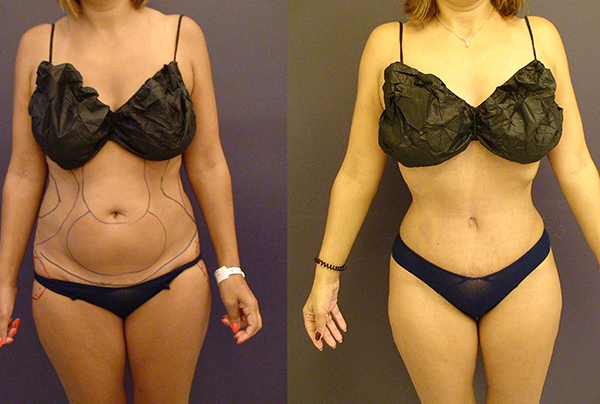 Before and After Image: Patient 19 - front