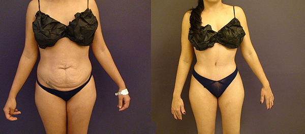 Before and After Image: Patient 20 - front
