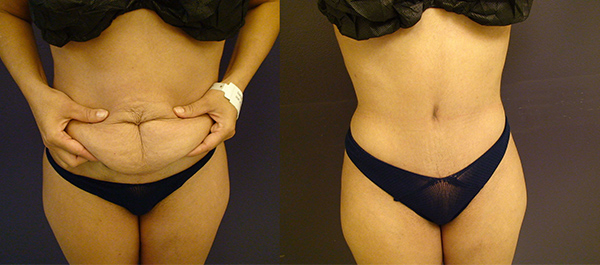 Before and After Image: Patient 20 - front