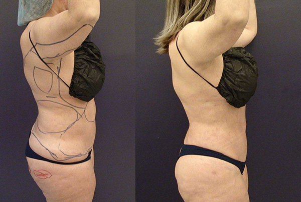 Before and After Image: Patient 21 - right-side