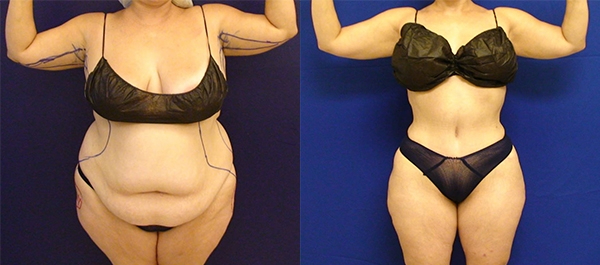 Before and After Image: Patient 22 - front