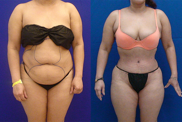 Before and After Image: Patient 23 - front