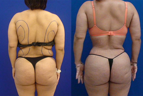 Before and After Image: Patient 23 - back