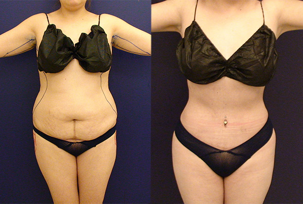 Before and After Image: Patient 24 - front