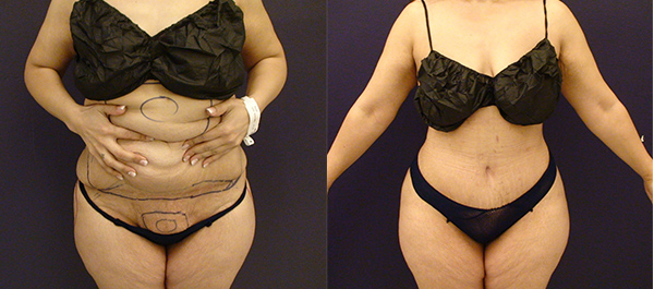 Before and After Image: Patient 25 - front