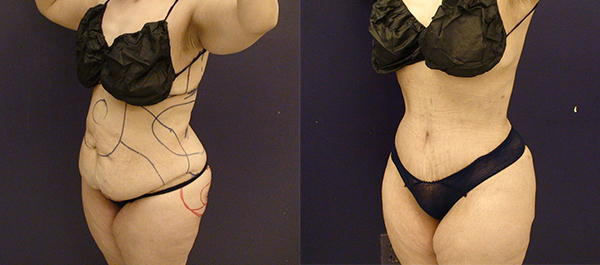 Before and After Image: Patient 25 - left-front-oblique