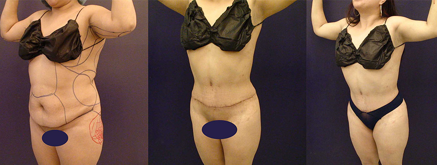 Before and After Image: Patient 26 - left-front-oblique