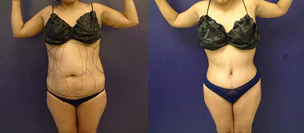 Before and After Image: Patient 3 - front
