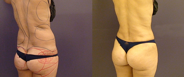 Before and After Image: Patient 4 - right-back-oblique