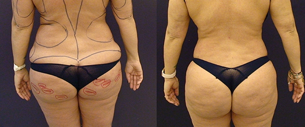 Before and After Image: Patient 6 - back