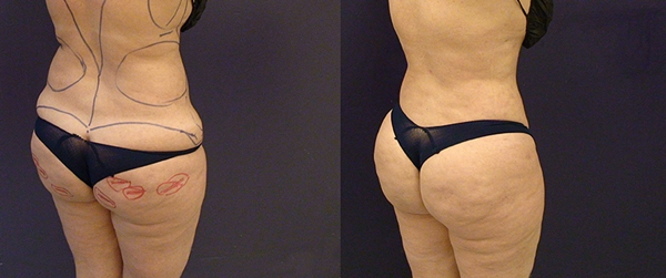 Before and After Image: Patient 6 - right-back-oblique