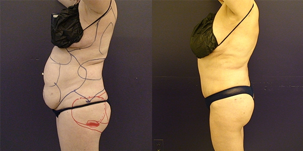 Before and After Image: Patient 7 - left-side