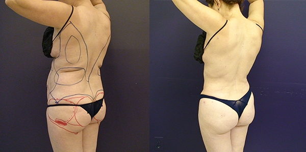 Before and After Image: Patient 8 - left-back-oblique