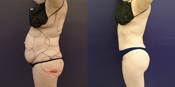 Before and After Image: Patient 8 - left-side