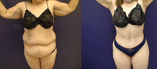 Before and After Image: Patient 9 - front