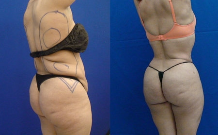 Before and After Image: Patient 1 - right-back-oblique