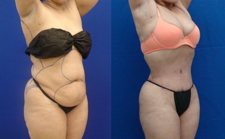 Before and After Image: Patient 1 - right-front-oblique