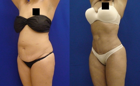 Before and After Image: Patient 2 - left-front-oblique