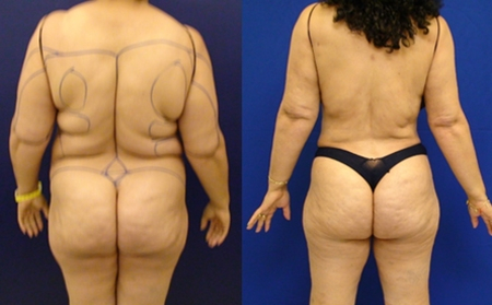 Before and After Image: Patient 3 - back