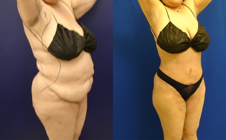 Before and After Image: Patient 3 - right-front-oblique