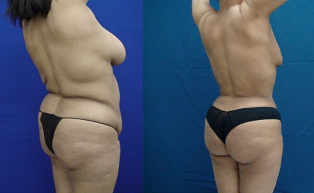 Before and After Image: Patient 4 - right-back-oblique