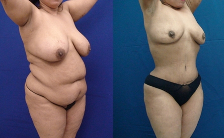 Before and After Image: Patient 4 - right-front-oblique
