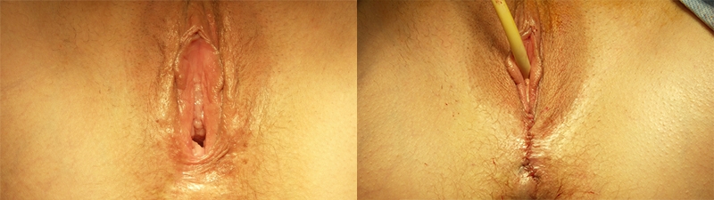 Before and After Image: Patient 1 - front