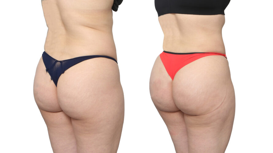 Before and After Image: Patient 6-1 - right-back-oblique