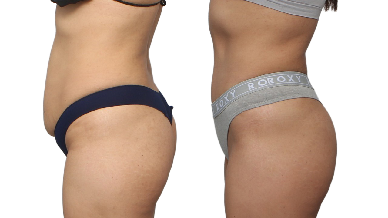 Before and After Image: patient 6 - left-side