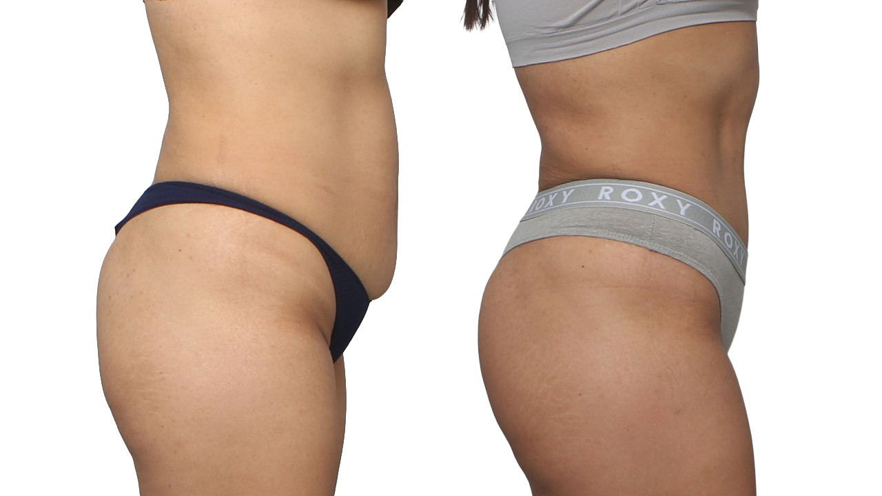 Before and After Image: patient 6 - right-side