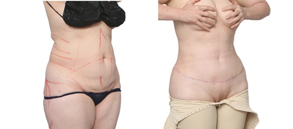 Before and After Image: Patient 27 - right-front-oblique