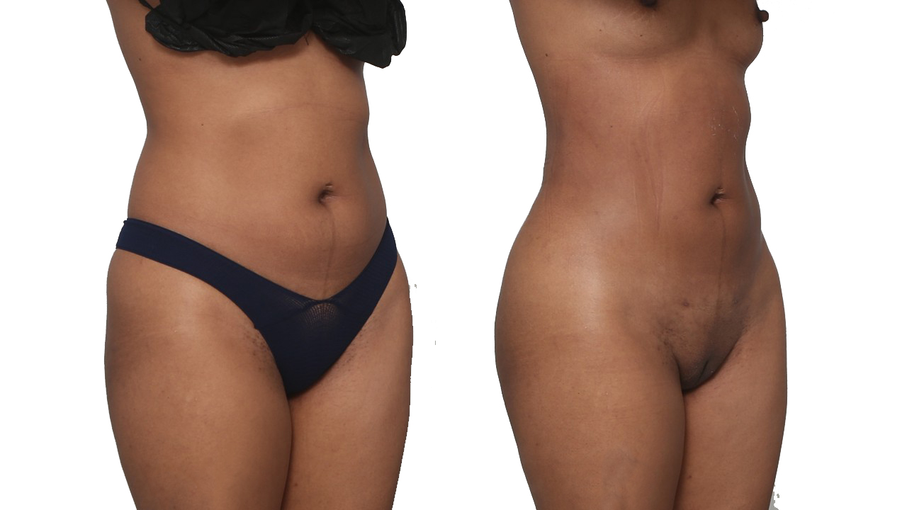 Before and After Image: Patient 7 - right-front-oblique