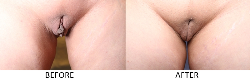 Clitoral Hood Reduction in Hudson County